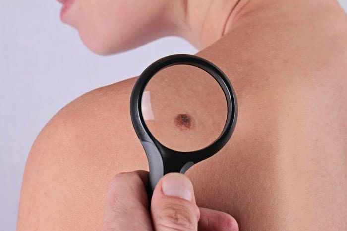 King’s College Hospital London - Abu Dhabi Shares Some Top Tips For Checking Your Skin